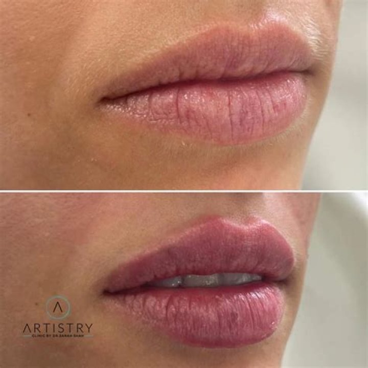 botox in the lips