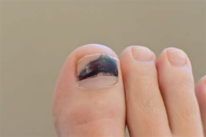 Try It: Toe Nail Strips